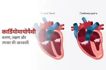 कार्डियोमायोपैथी (Cardiomyopathy - हृदय की मांसपेशियों का कमजोर होना)