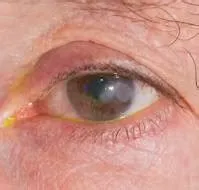 केराटाइटिस (Keratitis - कॉर्निया की सूजन)