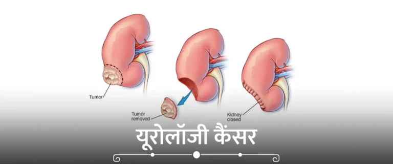 कॉन्जेनिटल एड्रेनल हाइपरप्लासिया (CAH)