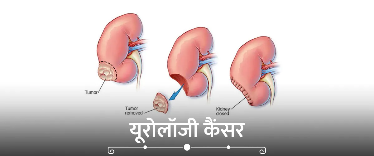 कॉन्जेनिटल एड्रेनल हाइपरप्लासिया (CAH)