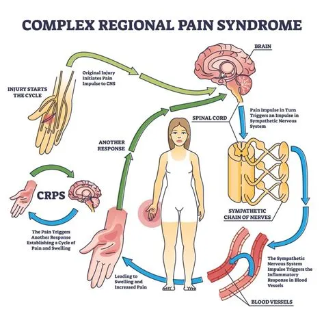 कॉम्प्लेक्स रीजनल पेन सिंड्रोम (Complex Regional Pain Syndrome - CRPS)