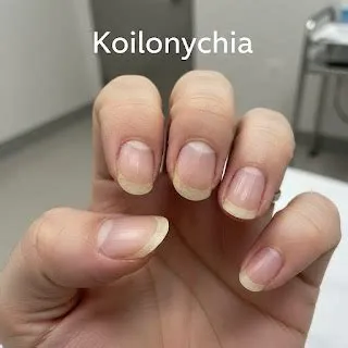 कोइलोनिकिया (Koilonychia - चम्मच के आकार के नाखून / आयरन की कमी)
