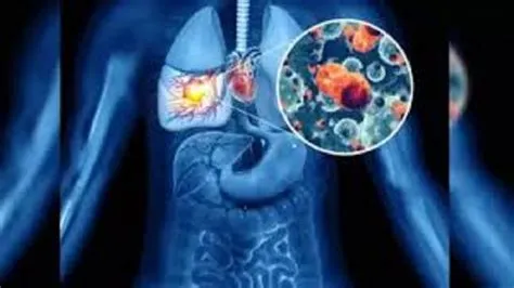 कोर पल्मोनेल (Cor Pulmonale - फेफड़ों के कारण हृदय के दाहिने हिस्से का फेल होना)