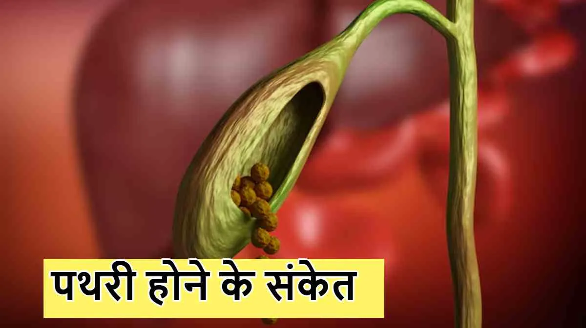 कोलेडोकोलिथियासिस (Choledocholithiasis - पित्त नली में पथरी)