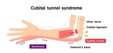 क्यूबाइटल टनल सिंड्रोम (Cubital Tunnel Syndrome - कोहनी की नस का दबना)