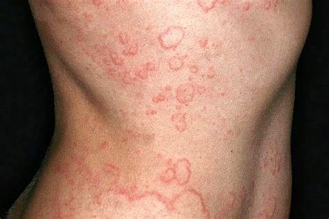 क्रोनिक इडियोपैथिक अर्टिकेरिया (Chronic Idiopathic Urticaria - पुरानी पित्ती)