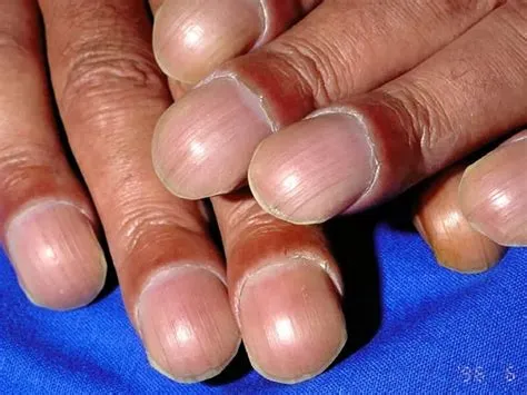 क्लबिंग ऑफ फिंगर्स (Clubbing of fingers - उंगलियों के सिरों का चौड़ा होना)