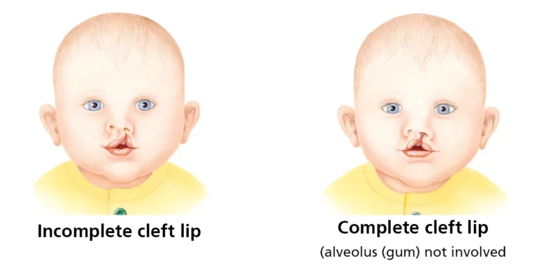 क्लैफ्ट पैलेट (Cleft Palate - तालु का कटा होना)