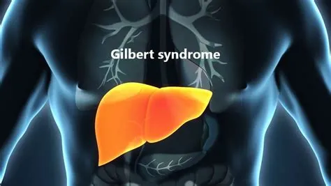 गिल्बर्ट सिंड्रोम (Gilbert's Syndrome - आनुवंशिक लिवर विकार)