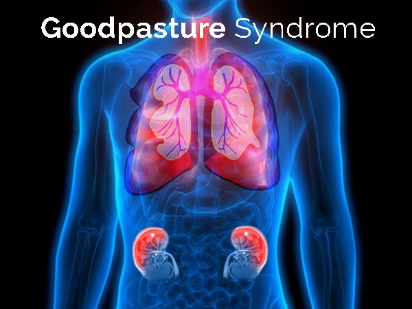गुडपास्चर सिंड्रोम (Goodpasture Syndrome)