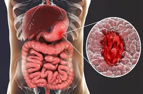 गैस्ट्रिक अल्सर (Gastric Ulcer - पेट के अल्सर)