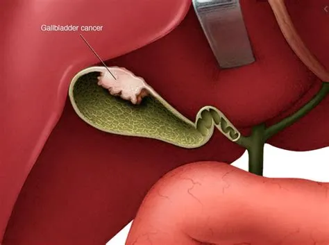 गॉल ब्लैडर कैंसर (Gallbladder Cancer - पित्ताशय का कैंसर)