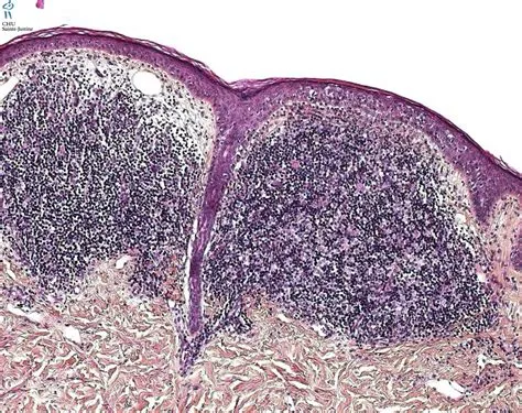 ग्रैनुलोमा इन्गुइनाले (Granuloma Inguinale - डोनोवानोसिस)
