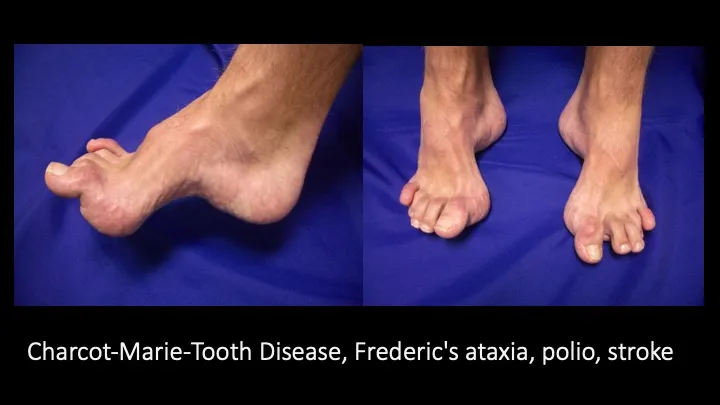 चारकोट-मैरी-टूथ रोग (Charcot-Marie-Tooth Disease - नसों का आनुवंशिक रोग)