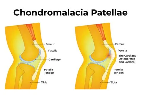 चोंड्रोमलेशिया पटेला (Chondromalacia Patellae - रनर्स नी)