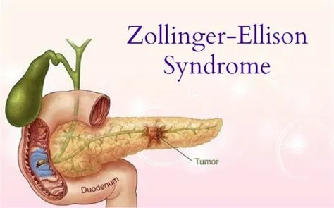ज़ोलिंगर-एलिसन सिंड्रोम (Zollinger-Ellison Syndrome)