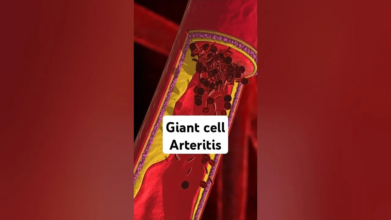 जाइंट सेल आर्टेराइटिस (Giant Cell Arteritis)