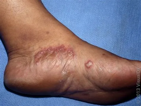 टिनिया पेडिस (Tinea Pedis - एथलीट्स फुट)