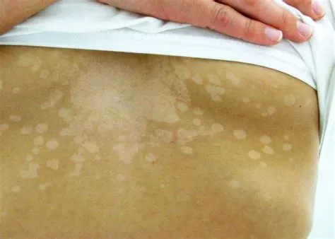 टिनिया वर्सीकोलर (Tinea Versicolor - त्वचा पर सफेद/भूरे रंगीन धब्बे)