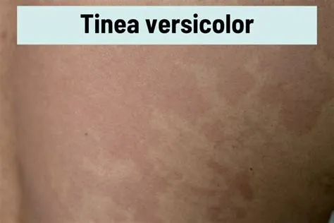 टिनिया वर्सीकोलर (Tinea Versicolor)