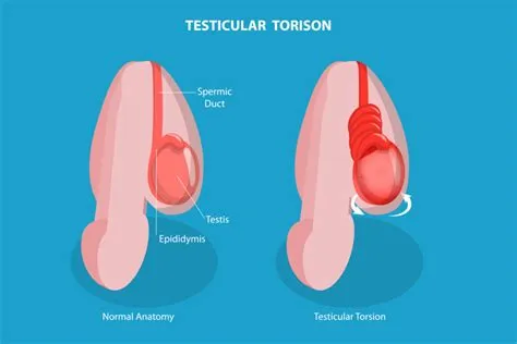 टेस्टिकुलर टॉर्शन (Testicular Torsion - अंडकोष का मुड़ना)