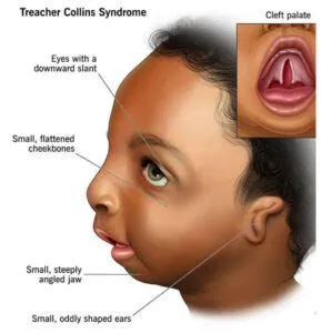 ट्रीचर कॉलिन्स सिंड्रोम (Treacher Collins Syndrome)