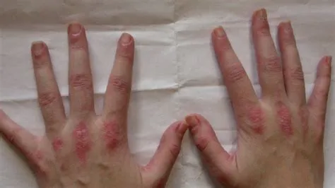 डर्माटोमायोसिटिस (Dermatomyositis - त्वचा और मांसपेशियों की सूजन)