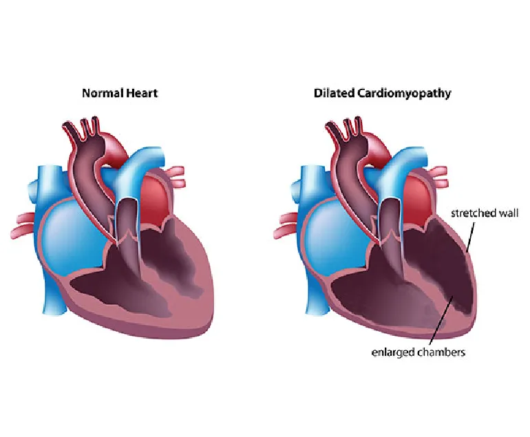 डाइलटेड कार्डियोमायोपैथी (Dilated Cardiomyopathy)