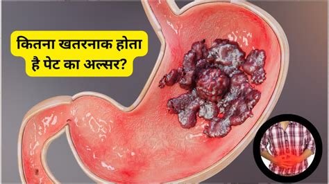 डुओडेनल अल्सर (Duodenal Ulcer - छोटी आंत के अल्सर)