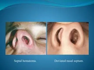 नेजल सेप्टल हेमेटोमा (Nasal Septal Hematoma - नाक की हड्डी में खून जमना)