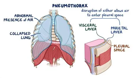 न्यूमोथोरैक्स (Pneumothorax - फेफड़ों का कोलैप्स होना)