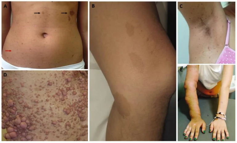न्यूरोफाइब्रोमैटोसिस (Neurofibromatosis टाइप 1 और 2)