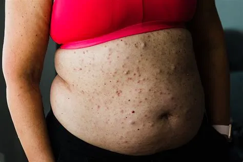 न्यूरोफाइब्रोमैटोसिस (Neurofibromatosis - नसों पर ट्यूमर बनना)