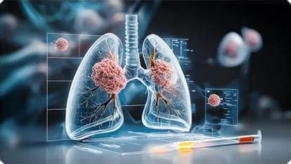 पल्मोनरी एल्वियोलर माइक्रोलिथियासिस (Pulmonary Alveolar Microlithiasis)