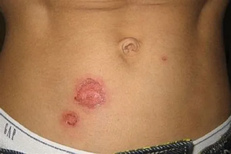 पायोडर्मा गैंग्रीनोसम (Pyoderma Gangrenosum - त्वचा पर गहरे और बड़े अल्सर)