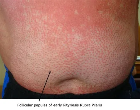 पिटीरियासिस रूब्रा पिलारिस (Pityriasis Rubra Pilaris - PRP)