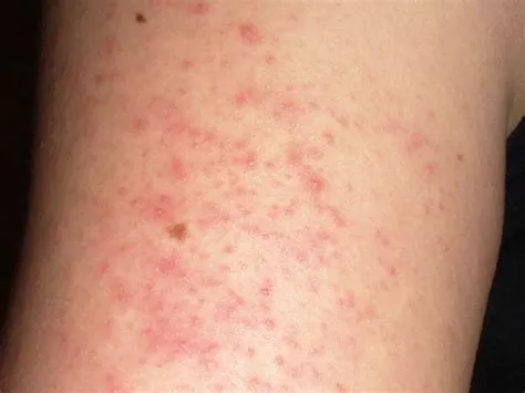 पीटीरियासिस रूब्रा पिलारिस (Pityriasis Rubra Pilaris)