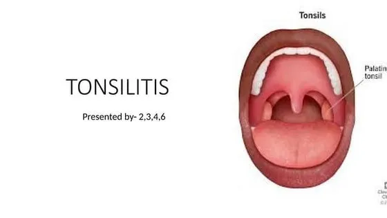 पेरिटॉन्सिलर एब्सेस (Peritonsillar Abscess / Quinsy)
