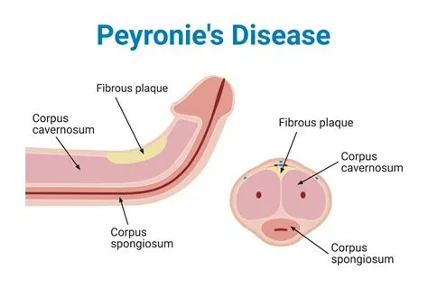 पेरोनी रोग (Peyronie's Disease)