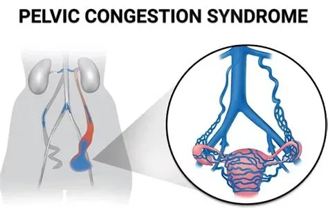पेल्विक कंजेशन सिंड्रोम (Pelvic Congestion Syndrome - पेल्विक क्षेत्र की नसों में सूजन)