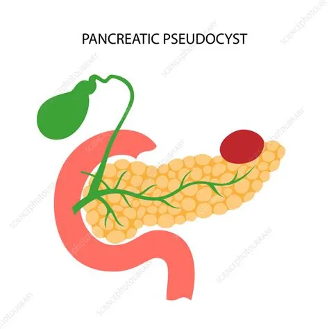 पैन्क्रिएटिक स्यूडोसिस्ट (Pancreatic Pseudocyst - अग्न्याशय में तरल पदार्थ की थैली)
