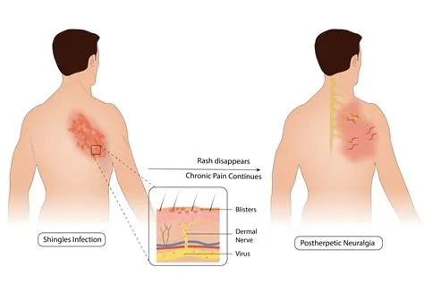 पोस्ट-हरपेटिक न्यूराल्जिया (Postherpetic Neuralgia)