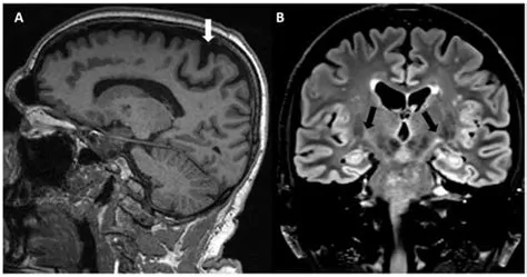 प्राइमरी लेटरल स्क्लेरोसिस (Primary Lateral Sclerosis)
