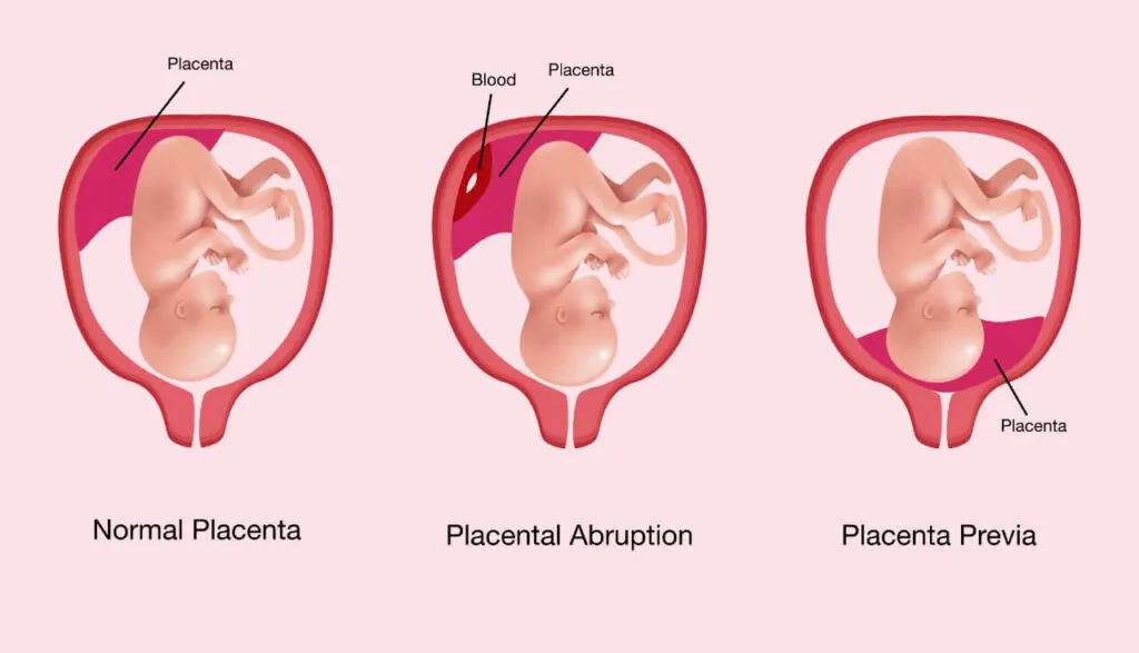 प्लेसेंटल एबर्प्शन (Placental Abruption - डिलीवरी से पहले गर्भनाल का अलग होना)