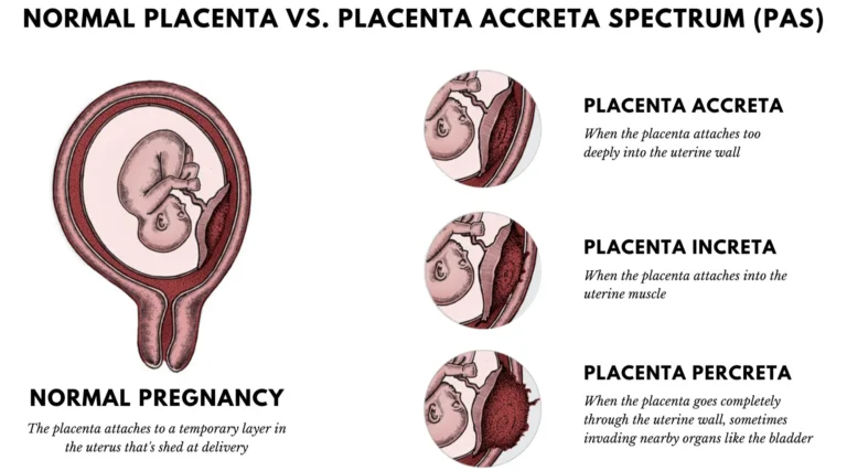 प्लेसेंटा एक्रीटा (Placenta Accreta - गर्भनाल का गर्भाशय की दीवार में बहुत गहराई तक जुड़ना)