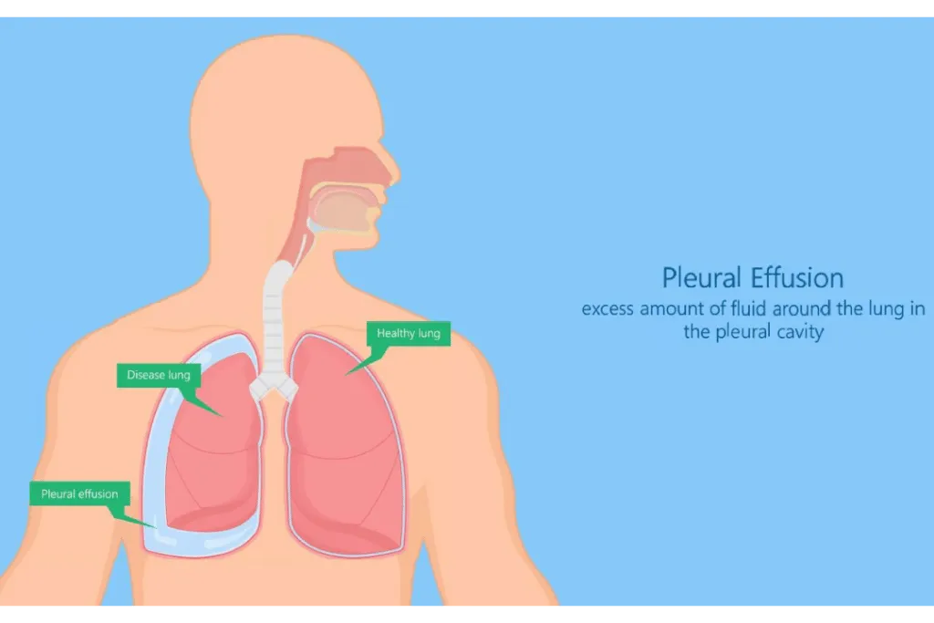 प्ल्यूरल इफ्यूजन (Pleural Effusion - फेफड़ों के बाहर पानी भरना)