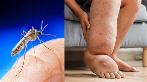 फाइलेरिया (Filariasis / Elephantiasis - हाथीपांव)