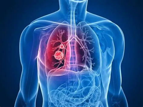 फार्मर्स लंग (Farmer's Lung - फफूंदीयुक्त घास से फेफड़ों का रोग)