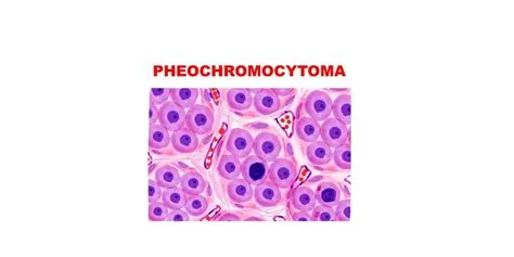 फेयोक्रोमोसाइटोमा (Pheochromocytoma - एड्रेनल ग्रंथि का ट्यूमर)