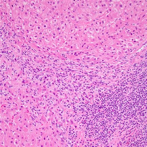 फोकल नोड्यूलर हाइपरप्लासिया (Focal Nodular Hyperplasia - लिवर का ट्यूमर)